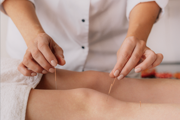 Acupuncture